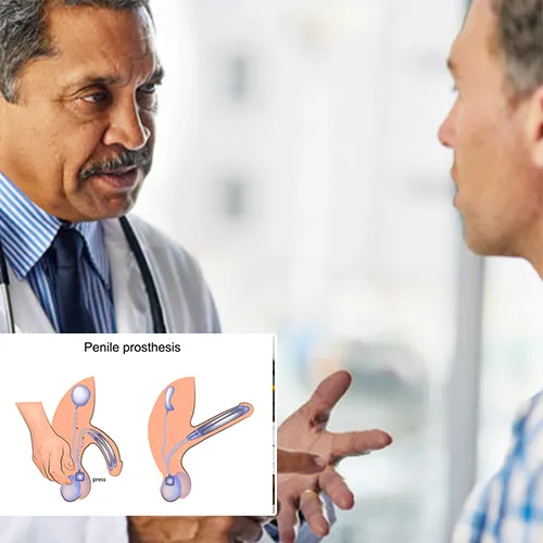Welcome to  Wauwatosa Surgery Center

Your Guide to Penile Implants